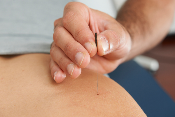 Dry Needling Mesa AZ, Intramuscular Stimulation (IMS)